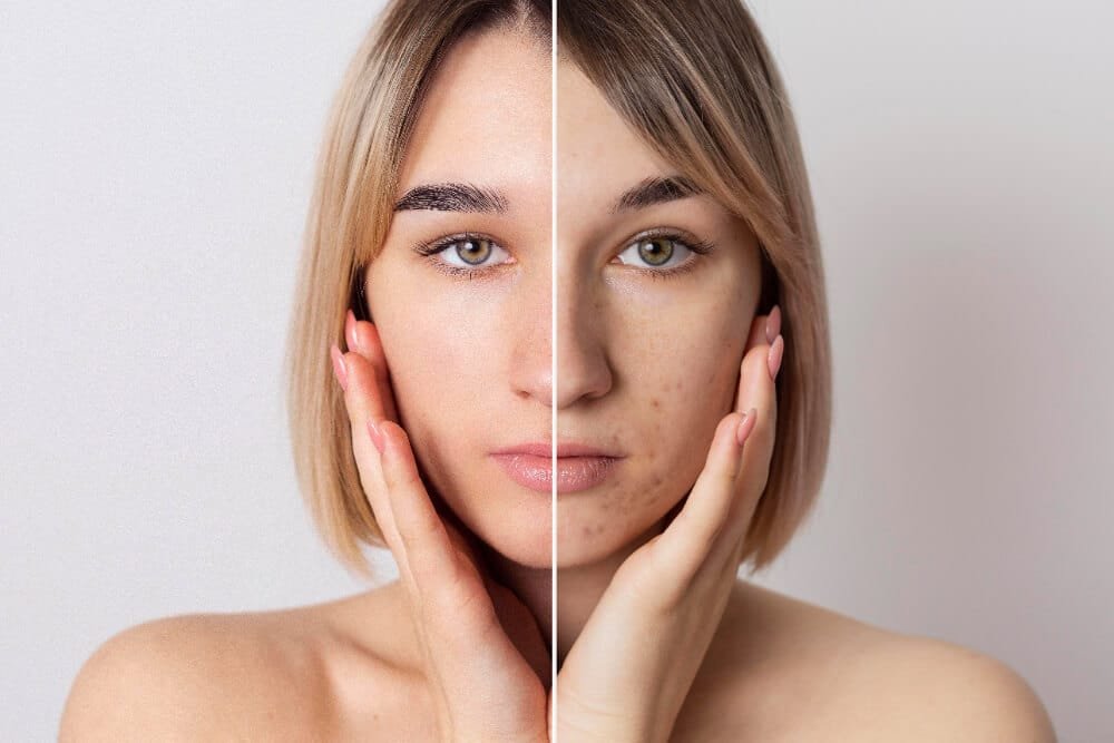 Pigmentation Disorders